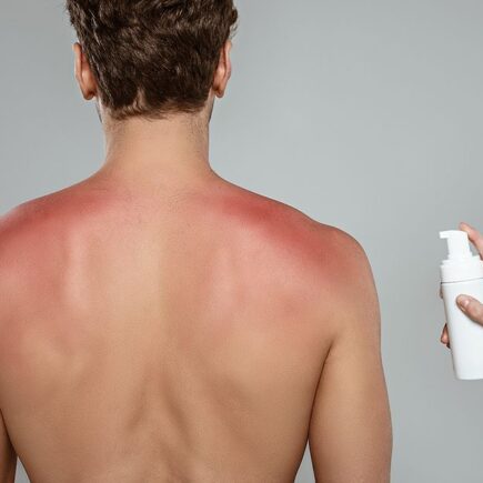 Quemadura de sol en hombre