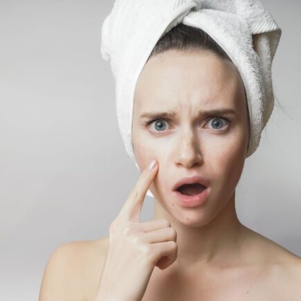 Mujer con imperfecciones faciales